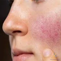 redness Reduction